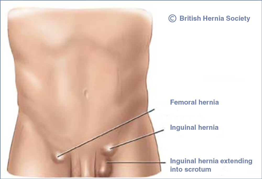 Femoral Hernia